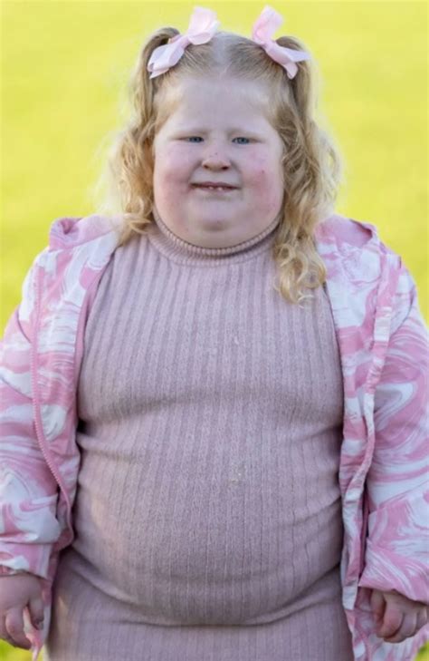 prada willi symdrome|prader willi syndrome in females.